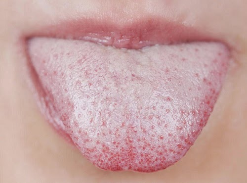 Nấm Candida nguy hiểm với trẻ sơ sinh và cách chữa trị