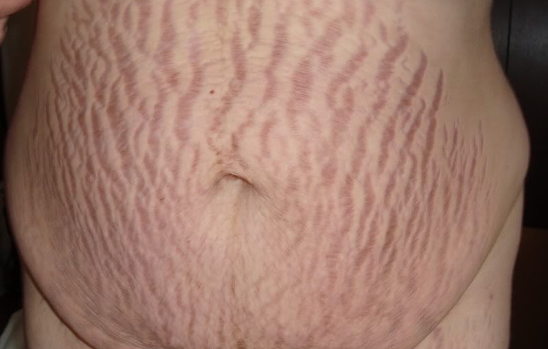 8 cách xóa rạn da cực kỳ tiết kiệm cho bà bầu