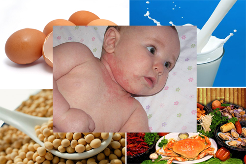 Trẻ bị dị ứng thực phẩm và những điều mẹ cần biết
