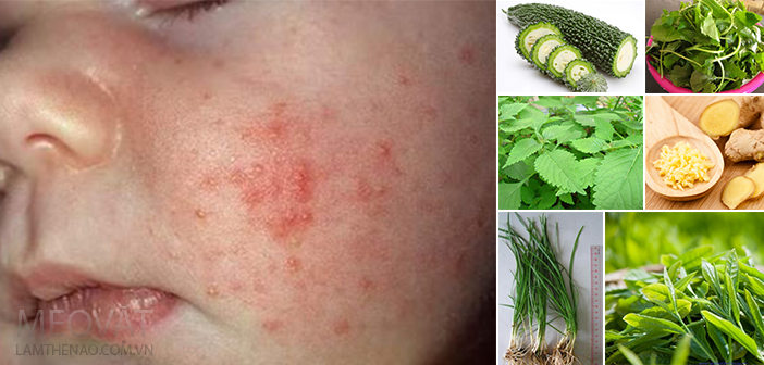 8 bài thuốc dân gian trị rôm sảy cho trẻ nhỏ hiệu quả vào mùa hè