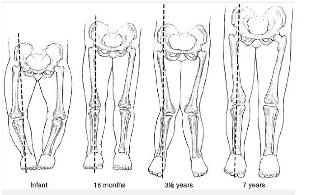 Đóng bỉm/tã cho bé sớm liệu có sợ bị chân vòng kiềng không? tã cho bé