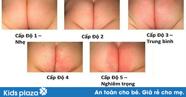 Tác hại nghiêm trọng của việc lạm dụng đóng bỉm cho bé Tác hại nghiêm trọng của việc lạm dụng đóng bỉm cho con