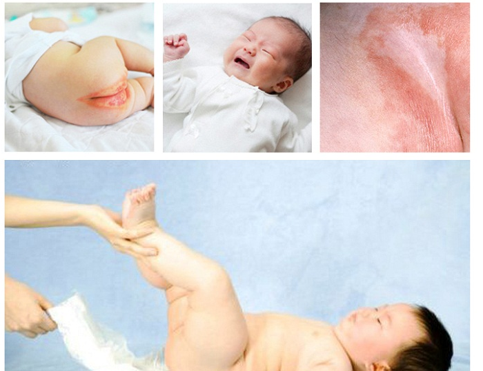 Kinh nghiệm chữa hăm tã hiệu quả và cách phòng chống hăm ở trẻ