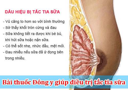 mẹo chữa tắc tia sữa 