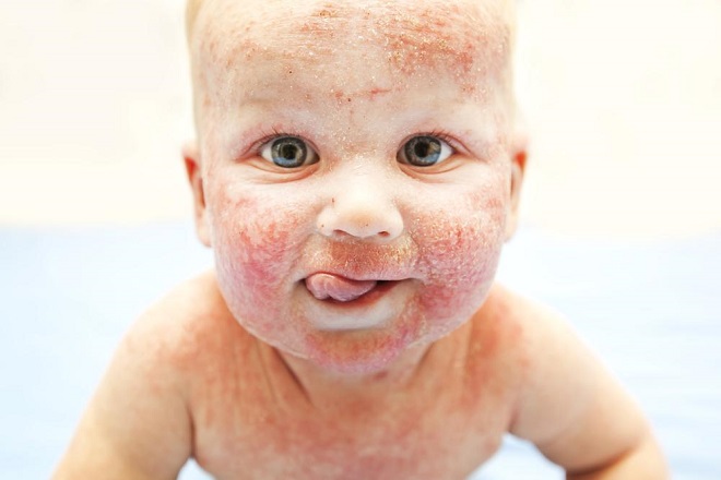 Chàm eczema ở trẻ sơ sinh