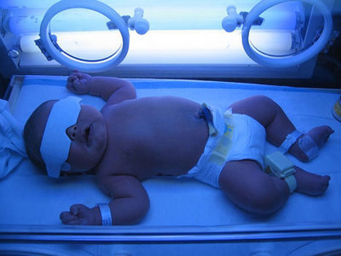 phương pháp chiếu đèn cho bệnh vàng da ở trẻ sơ sinh
