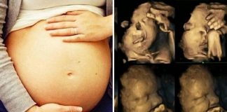 Dị tật hở hàm ếch là gì? Liệu hở hàm ếch ở trẻ có thể chữa trị được không?