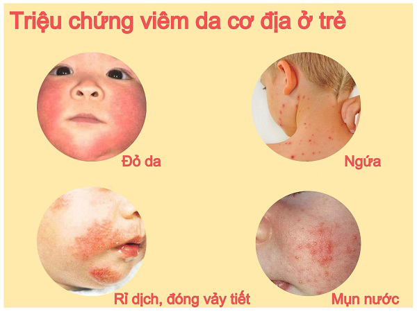 Viêm da cơ địa ở trẻ sơ sinh