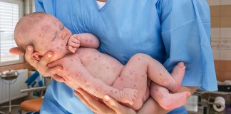 Dịch sởi bùng phát – Hậu quả kinh hoàng của trào lưu “anti vắc xin”