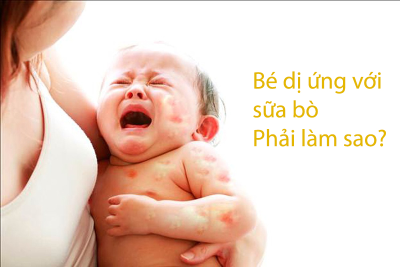 bé dị ứng sữa bò