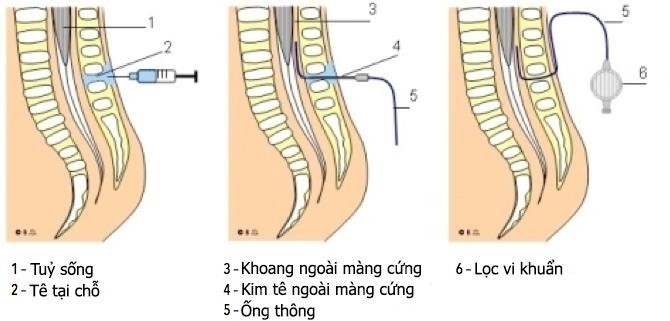 Kỹ thuật gây tê ngoài màng cứng