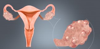 Đa nang buồng trứng có chữa khỏi được không? Chữa bằng phương pháp gì?