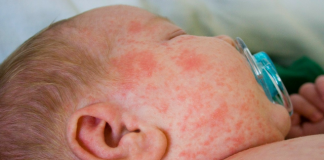 Bệnh sởi và những điều cần biết trong mùa dịch COVID-19