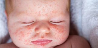 Cách xử lý rôm sảy cho bé yêu