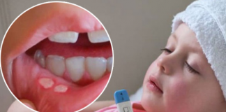 Cha mẹ cần làm gì khi con bị nhiệt miệng?