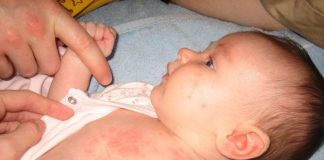 Bé bị sốt phát ban có nguy hiểm không? Cách điều trị hiệu quả? be-bi-sot-phat-ban