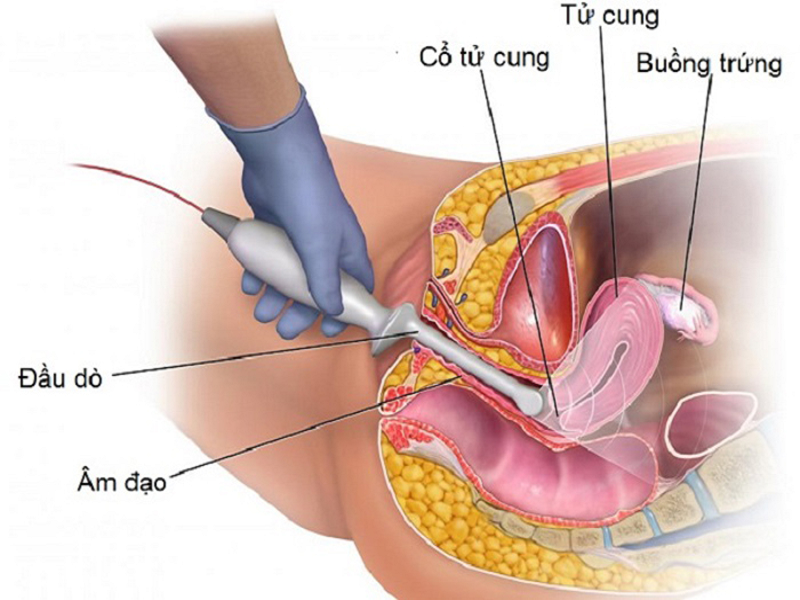 sieu-am-dau-do-co-dau-khong-1