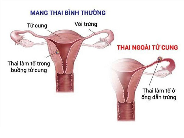 thai-ngoai-tu-cung-sieu-am-co-thay-khong-1.png