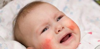 Trẻ bị dị ứng thời tiết có nguy hiểm không? Cách điều trị hiệu quả? tre-bi-di-ung-thoi-tiet