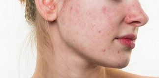 Mang thai có mọc mụn không? Nguyên nhân gây mụn ở bà bầu