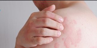 Giải mã bệnh nổi mề nổi mề đay nguyên nhân và triệu chứng me-day-la-g-1