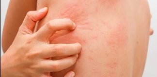 Nổi mề đay nên ăn gì? Bí quyết ăn uống đúng cách kiểm soát tình trạng nổi mề đay nổi mề đay nên ăn gì-1