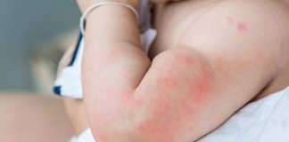 Nổi mề đay ở trẻ em kiêng gì? Những điều cần nên biết noi-me-day-o-tre-em-kieng-gi-1