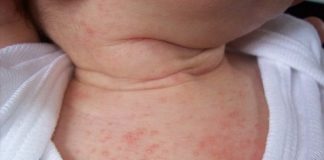 Rôm sảy có tự hết không? Một số lưu ý cần biết rom-say-co-tu-het-khong-2