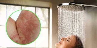 Nổi mề đay kiêng tắm hay không? Những điều cần biết về bệnh nổi mề đay