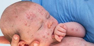 Bệnh sởi ở trẻ em: Triệu chứng và cách phòng tránh hiệu quả benh-soi-o-tre-em