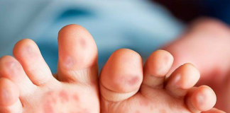 Mách mẹ: Trẻ bị chân tay miệng nên kiêng gì? kiêng ăn gì?