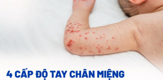 4 giai đoạn bệnh tay chân miệng ở trẻ: Nhận biết sớm – Ngăn ngừa kịp thời