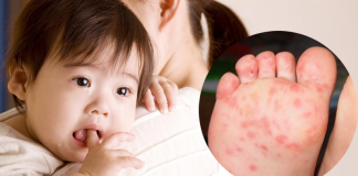 Giải đáp: Chân tay miệng ở trẻ có lây không?