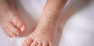 Hướng dẫn ba mẹ cách xử lý da cáy ở trẻ sơ sinh