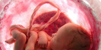 Nguyên nhân và dấu hiệu mẹ bầu bị đa ối: Cách nhận biết sớm để kịp thời xử lý