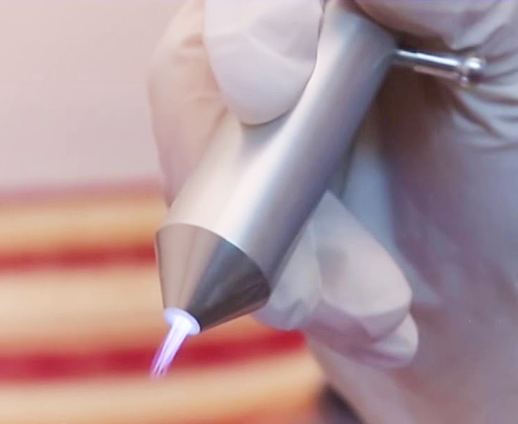 chiếu tia plasma vào vết khâu tầng sinh môm