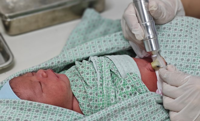 chiếu tia plasma cuống rốn mấy lần