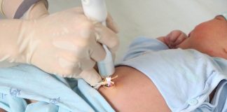 Chiếu tia plasma cho cuống rốn: Bao nhiêu lần? Có cần thiết không?