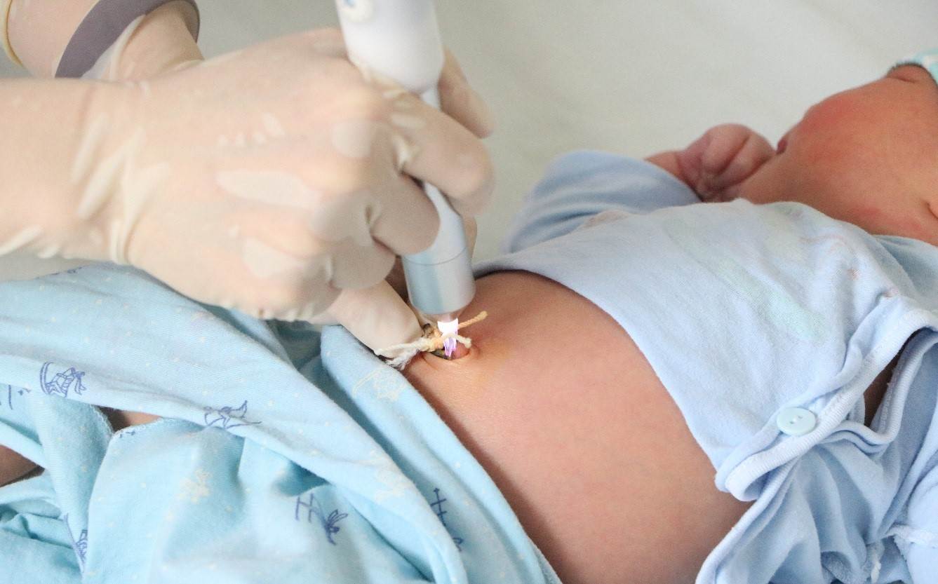 chiếu tia plasma cuống rốn mấy lần