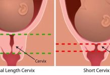 Cổ tử cung dài có khó sinh không? Bác sĩ giải đáp & lưu ý chuyển dạ