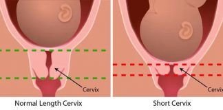 Cổ tử cung dài có khó sinh không? Bác sĩ giải đáp & lưu ý chuyển dạ