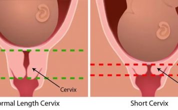 Cổ tử cung dài có khó sinh không? Bác sĩ giải đáp & lưu ý chuyển dạ
