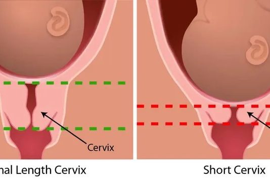 Cổ tử cung dài có khó sinh không? Bác sĩ giải đáp & lưu ý chuyển dạ