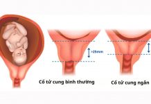 Cổ tử cung ngắn nên làm gì? Kiêng gì? 7 giải pháp giúp mẹ bầu yên tâm