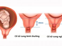 Cổ tử cung ngắn nên làm gì? Kiêng gì? 7 giải pháp giúp mẹ bầu yên tâm