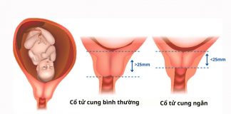 Cổ tử cung ngắn nên làm gì? Kiêng gì? 7 giải pháp giúp mẹ bầu yên tâm