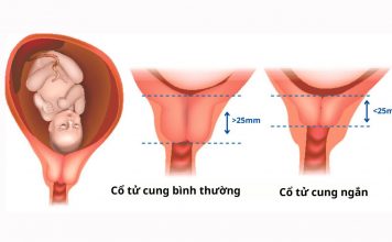 Cổ tử cung ngắn nên làm gì? Kiêng gì? 7 giải pháp giúp mẹ bầu yên tâm