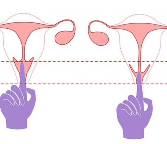 Cổ tử cung ngắn là như thế nào? Dấu hiệu & cách nhận biết
