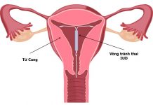 Cổ tử cung ngắn có đặt vòng được không? Khi nào nên trì hoãn tránh thai