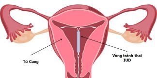 Cổ tử cung ngắn có đặt vòng được không? Khi nào nên trì hoãn tránh thai